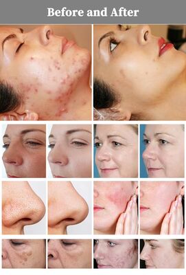 Portable New 1927nm Thulium Laser for Melasma Laser 1927 Thulium Micro Ablative 1927 Non Ablative Laser Thulium Facial Laser