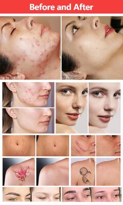 Vertical Fractional Co2 Laser And Picoseond Laser Within Two Handles Cutter Fractional 4D Q-Switched Nd Yag Laser Series Co2 Cutting Machine